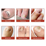 Fungal Nail Patches